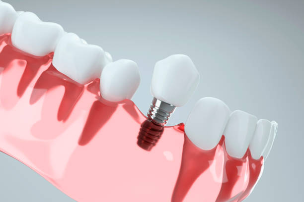 illustration showing how a dental implant is planted into the gums