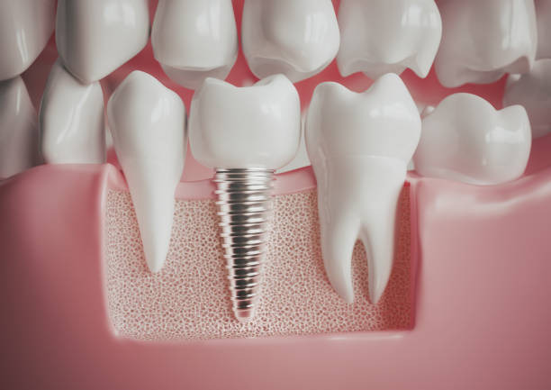 3D illustration of implant next to healthy teeth