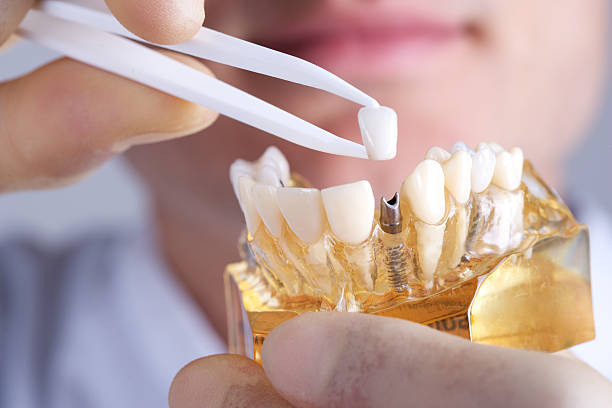 photo of a clear dental model with implant held by a person 