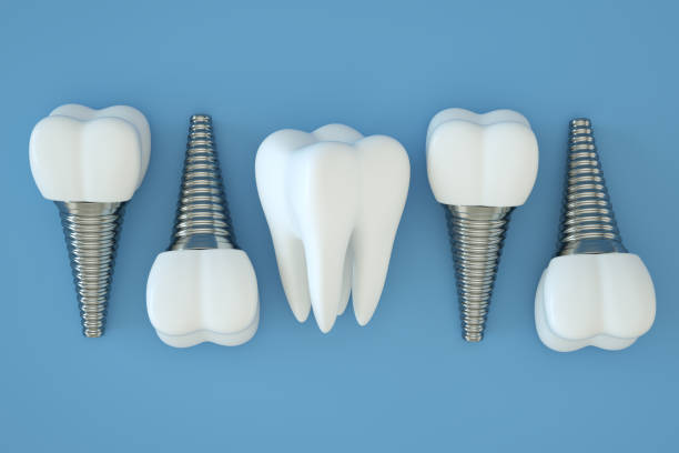 close-up shot of dental implants model with a healthy teeth