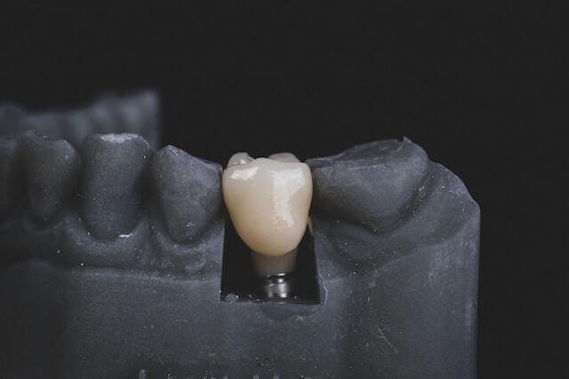 a black dental model of the lower jaw with implants