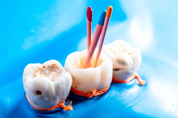 a photo showing severely decayed teeth